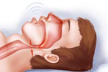 What is Sleep Apnea syndrome?