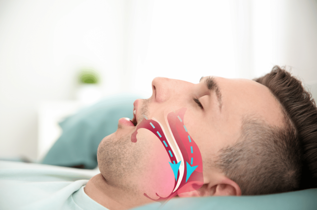 underlying condition causes sleep apnea